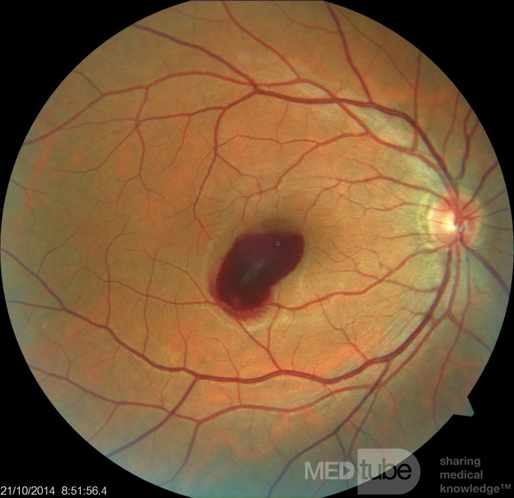 Preretinal Hemorrhage in 38 years old Patient During Sneezing
