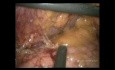 Laparoscopic Total Gastrectomy with D2 LND in Obese Patient (full video)