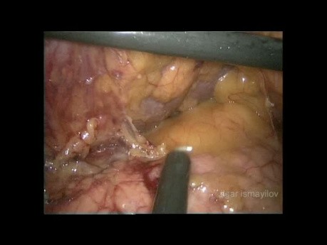 Laparoscopic Total Gastrectomy with D2 LND in Obese Patient (full video)