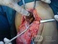 Liver hydatid cyst - operative finding