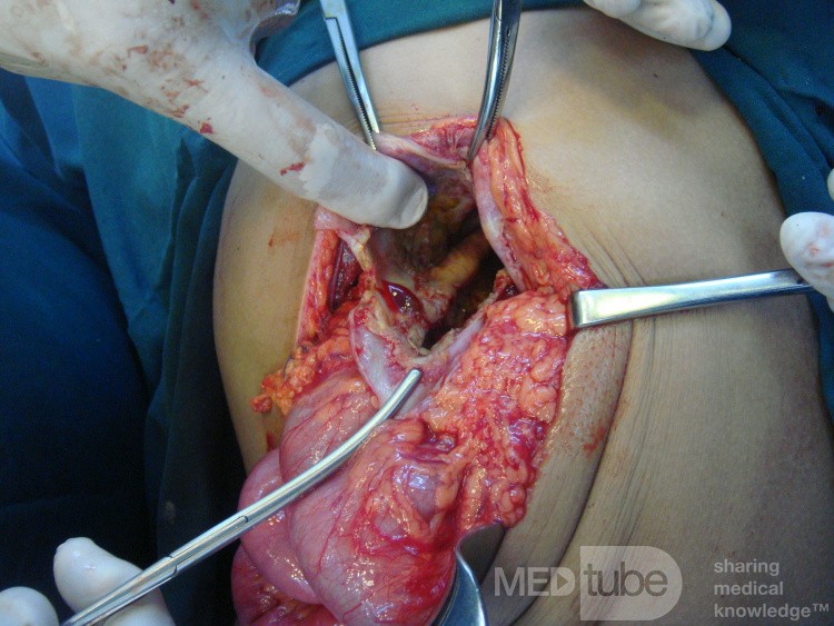 Liver hydatid cyst - operative finding