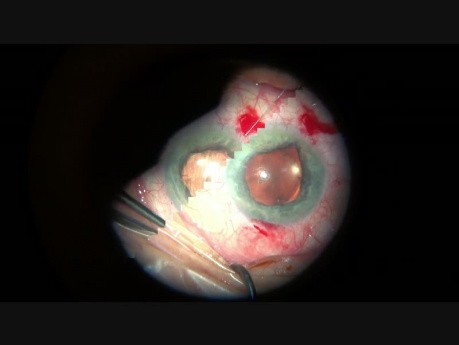 Plastic of Large Pupil