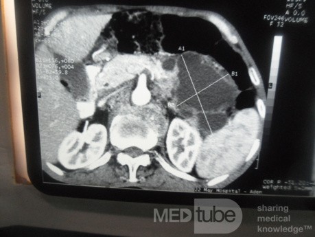 Pancreas cancer - 11