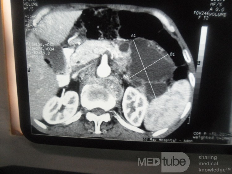 Pancreas cancer - 11