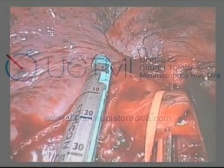 Uniportal VATS Middle Lobectomy Lung Cancer