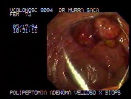 Video Colonoscopic view of a polypectomy of a big 6 cm. x 4 cm. sessile lesion (1 of 4)