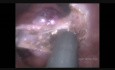 TransAnal Minimally Invasive Surgery (TAMIS) for T1 Malign Rectal Polyp