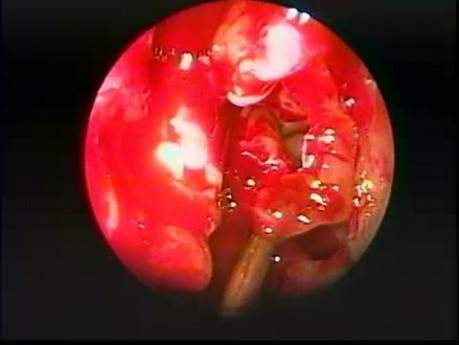Lacrimal Bone Dehiscence - Endoscopy