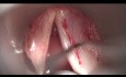 Sulcus Vocalis Type 2 (Vergeture)