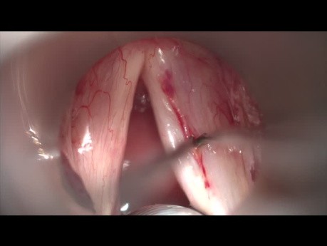Sulcus Vocalis Type 2 (Vergeture)