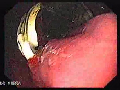 Penetration of Adjustable Laparoscopic Gastric Banding (2 of 4)