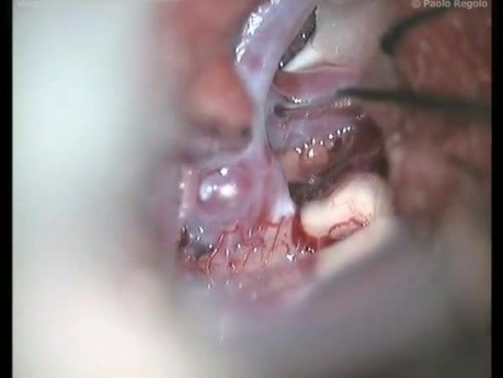 Carotid Bifurcation Aneurysm - Left Pterional Approach