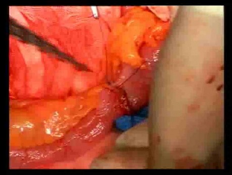 Open Right Hemicolectomy – Technical Principles - Operation No 2 - Part 5