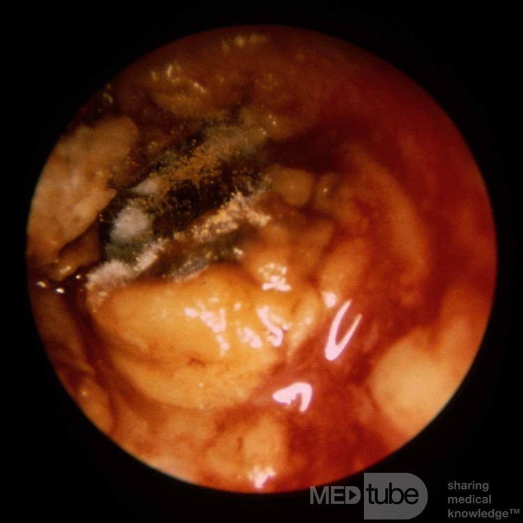 Acute Severe Otomycosis