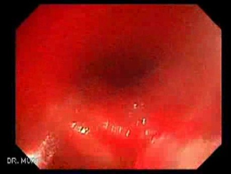 Giant Tubulo - Villous Adenoma (10 of 17)