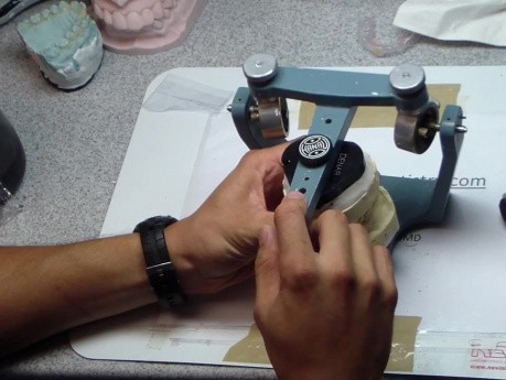 Anterior Waxup Correction Part 3 - Fast Method To Remount Case
