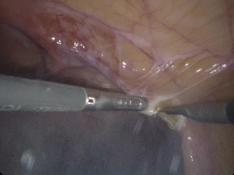 Laparoscopic Post Operative Ventral Hernia Repair