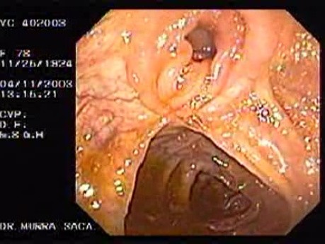 Adenocarcinoma Of The Transverse Colon - Endoscopy (8 of 9)