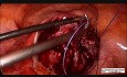 Laparoscopic Myomectomy for Posterior Intramural Fibroid in Unmarried Girl 