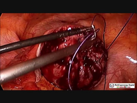 Laparoscopic Myomectomy for Posterior Intramural Fibroid in Unmarried Girl 