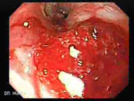 Esophagus - Pneumatic Dilation for Achalasia - Enlargement of the Esophagus