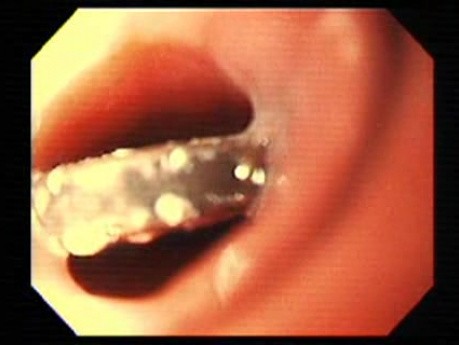 Foreign Body Ingestion (3 of 7)