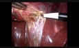  Laparoscopic Cholecystectomy + Umbilical Hernia Repair + Tubal Sterilisation