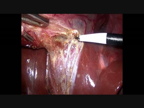 Laparoscopic Cholecystectomy + Umbilical Hernia Repair + Tubal Sterilisation