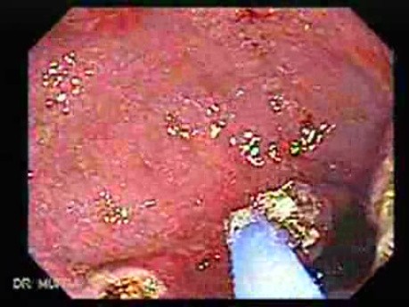 Multiple Adenomatous Polyps Of The Rectum (28 of 37)