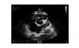 Interesting Case - a Young Immigrant with Previous Cardiac Surgery and an Abnormal Echo