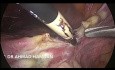 Total Laparoscopic Hysterectomy (AUB, Previous 3 C/S)