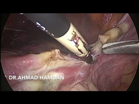 Total Laparoscopic Hysterectomy (AUB, Previous 3 C/S)
