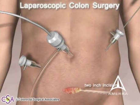 Colorectal cancer surgery - 3D Medical Animation