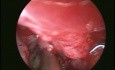 Maxillary Sinus Pyocele