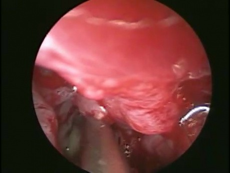 Maxillary Sinus Pyocele