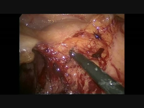 Laparoscopic Extended Right Colectomy