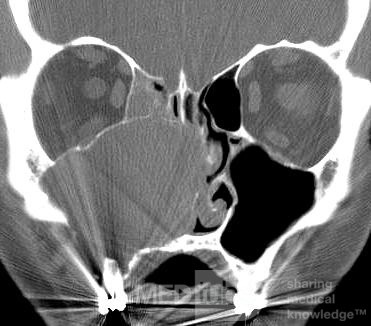 Giant Maxillary Sinus Mucocele [CT scan – coronal view]