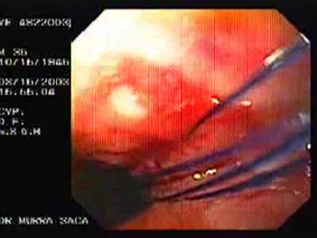 Flexible Endoscopic Suturing - Converting Four Threads into Two