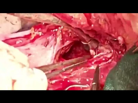 Innominate Artery Perforation Due to Double Lumen Insertion 