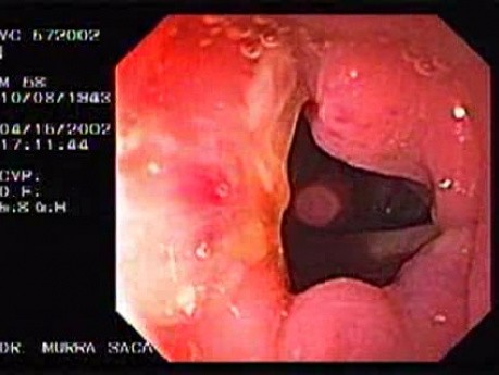 Diverticulitis Of The Sigmoid (2 of 2)
