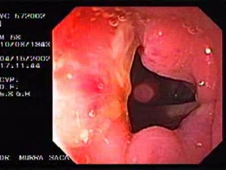 Diverticulitis Of The Sigmoid (2 of 2)