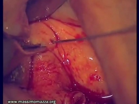 Regeneration Of Multialveolar Process (Left-Side) (2/3)