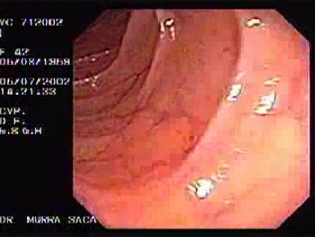 Crohn´s Disease (10 of 28)