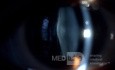 Posterior Lenticonus