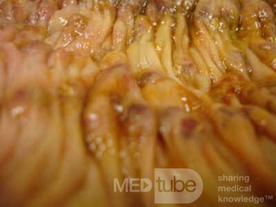 Toxic Dilatation of the Colon Superimposed pseudomembranous colitis involving the
 right colon (14 of 17)