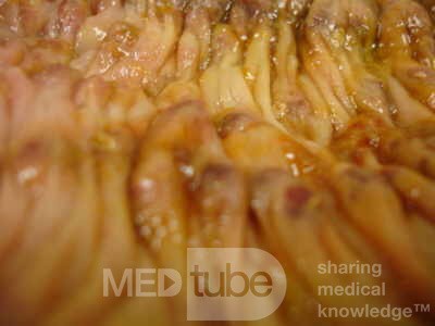 Toxic Dilatation of the Colon Superimposed pseudomembranous colitis involving the
 right colon (14 of 17)