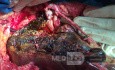 Left Hepatectomy extended to Segment I, for Type IIIb Colangiocarcinoma