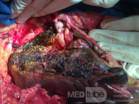 Left Hepatectomy extended to Segment I, for Type IIIb Colangiocarcinoma