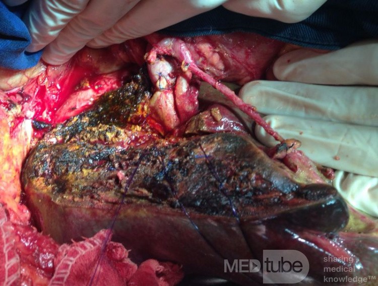 Left Hepatectomy extended to Segment I, for Type IIIb Colangiocarcinoma