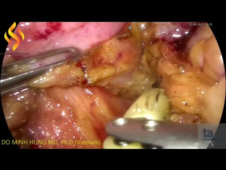 Lap Anterior Resection for Rectosigmoid Colon Cancer